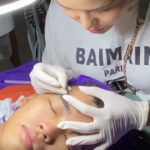 Chin Extractions