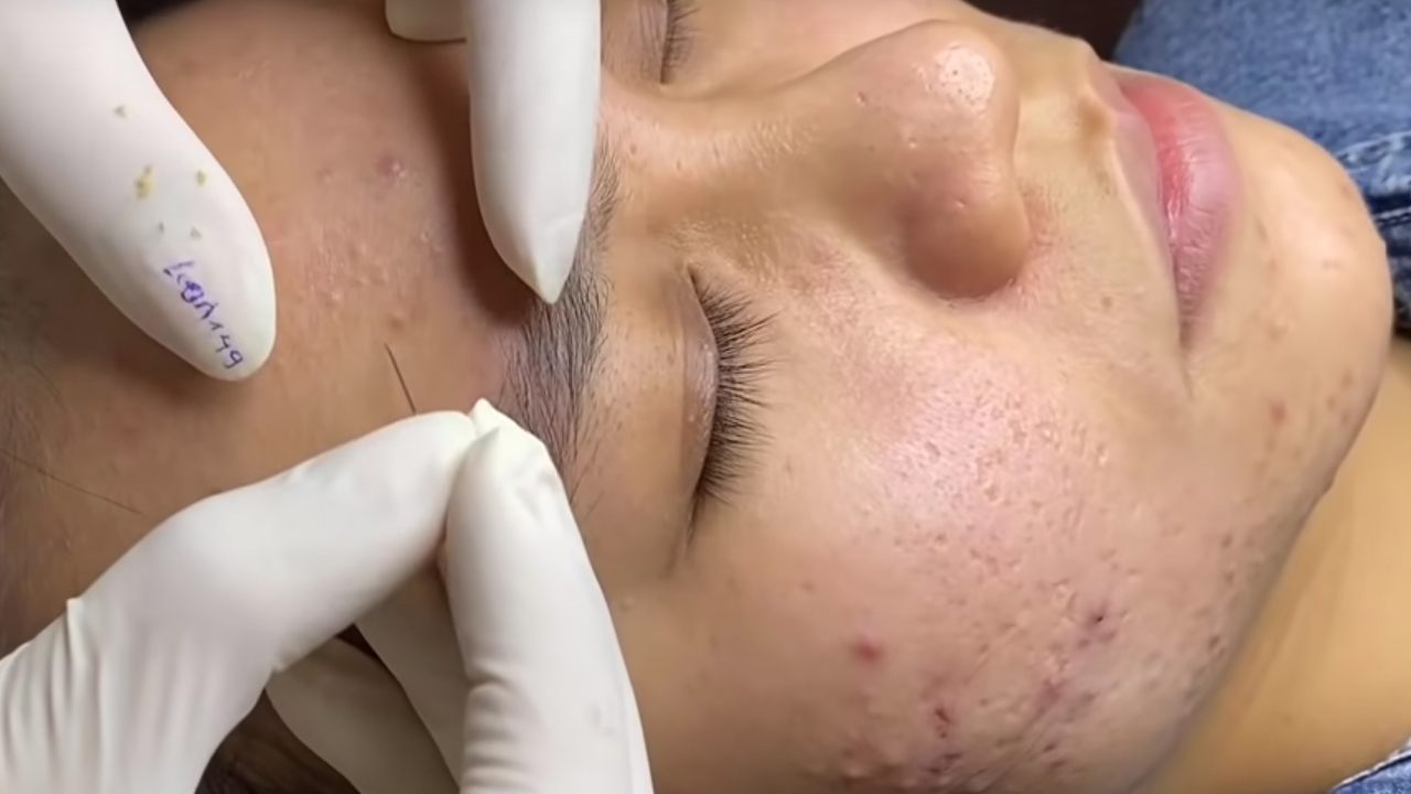 Asian Spa Extractions. Demonstration Video